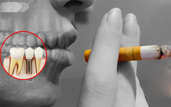 trồng răng Implant có được hút thuốc không
