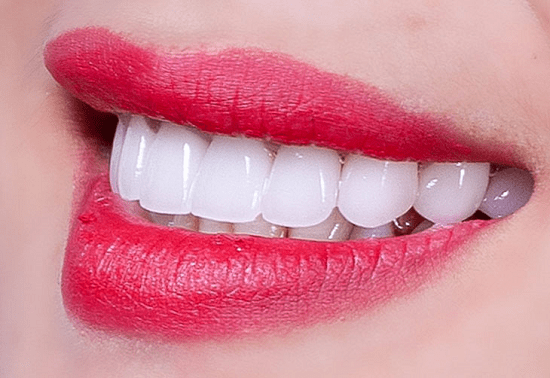 Bọc răng sứ 2 hàm giá bao nhiêu?