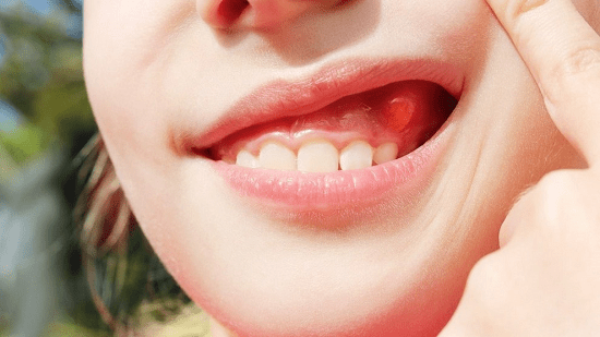 Nướu răng nổi cục thịt không đau là gì?