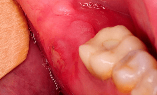 Làm gì khi bị sưng nướu răng trong cùng hàm dưới?