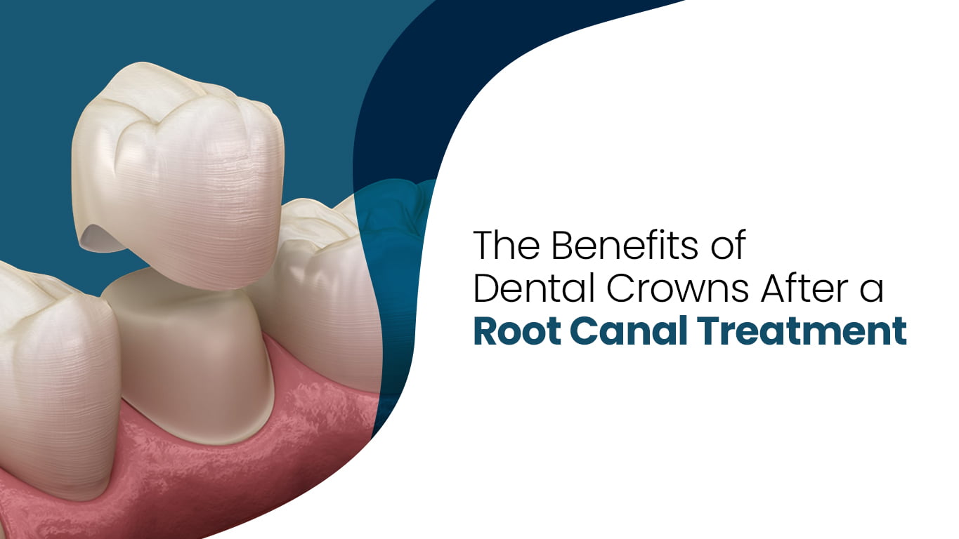 5 Benefits from Dental Crown After Root Canal Treatment
