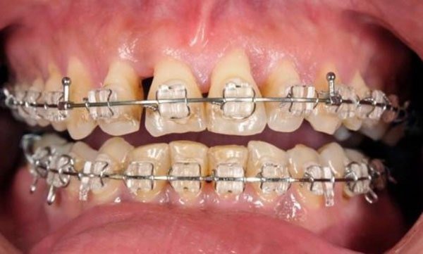 Tiêu xương khi niềng răng nguy hiểm như thế nào
