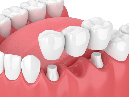 Vì sao làm cầu răng sứ làm xương hàm lại bị tiêu đi?