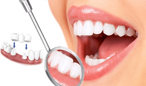 Tìm hiểu các kỹ thuật phục hình răng sứ thẩm mỹ