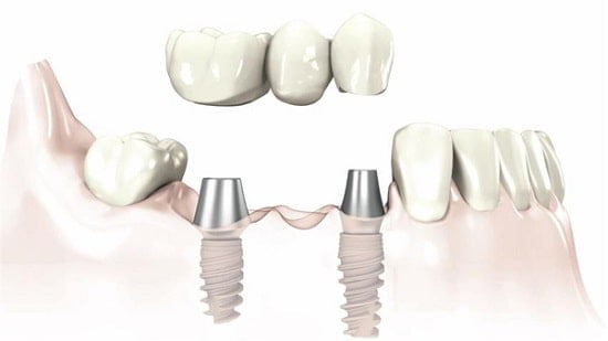 Quy trình trồng răng Implant khi bị tiêu xương sẽ diễn ra như thế nào?