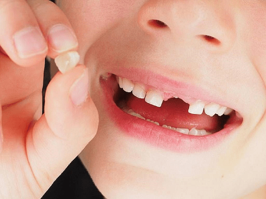 Gãy răng cửa phải làm sao? Phương pháp phục hình răng cho răng cửa bị gãy