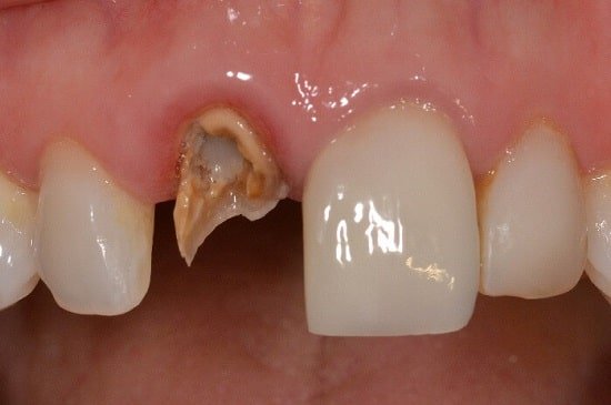 Cách khắc phục tình trạng răng lấy tủy bị vỡ