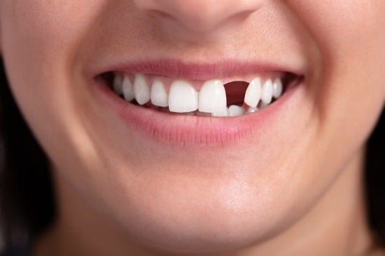 Mất răng số 2 khắc phục ra sao?