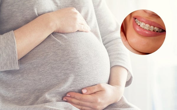 Phụ nữ mang thai niềng răng có ảnh hưởng tới thai nhi không