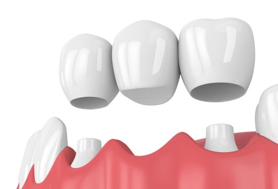 Cầu răng sứ là một phương án để thay thế 3 răng liền tiếp 
