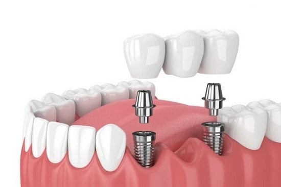 Phương pháp trồng 3 răng liên tiếp bằng Implant