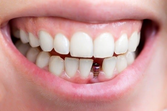 Trồng Implant Răng Cửa Bị Gãy Giá Bao Nhiêu Và Mất Bao Lâu?