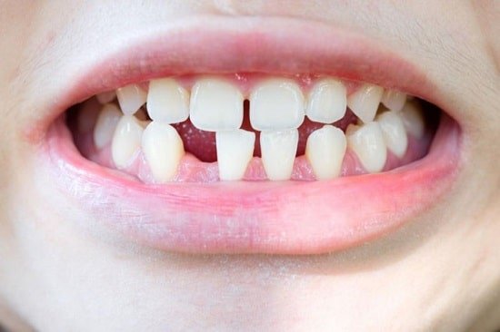 Thiếu mầm răng vĩnh viễn có nguy hiểm không?