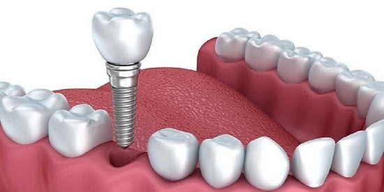 Lấy dấu implant là gì? Các giải pháp lấy dấu răng trên implant