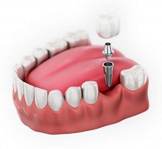 Trồng răng cấm Implant giá bao nhiêu?
