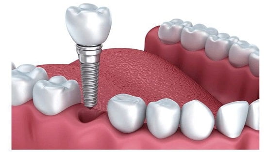 Đối tượng nào cần trồng răng Implant? Những trường hợp cụ thể