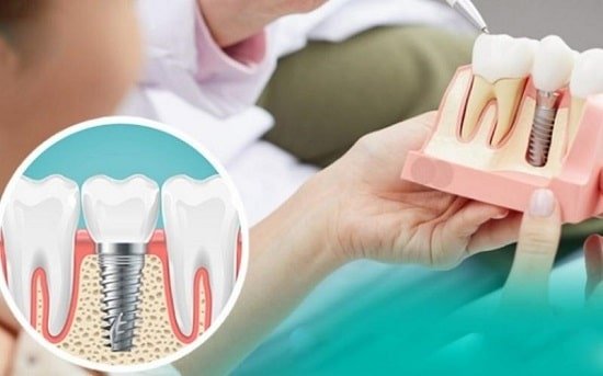 Làm răng Implant số 6 giá bao nhiêu?