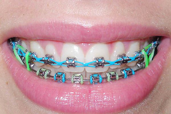 Cách sử dụng chun chuỗi niềng răng đúng cách?