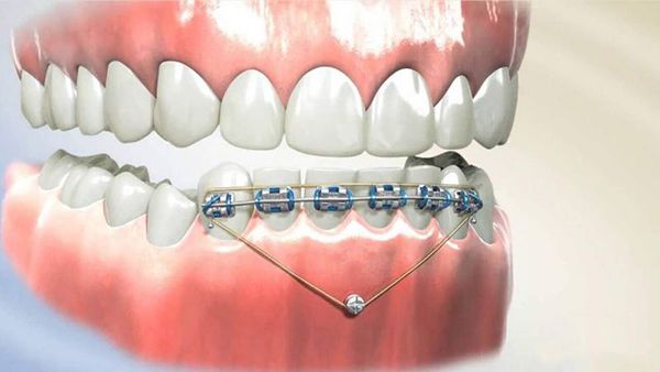 Có đau khi gắn minivis niềng răng không? 