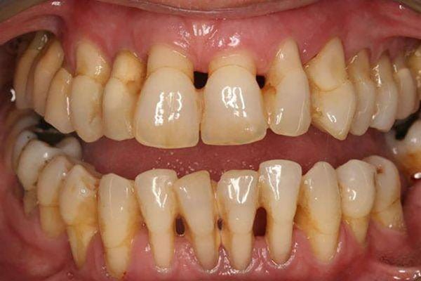 viêm nha chu răng lung lay là gì?