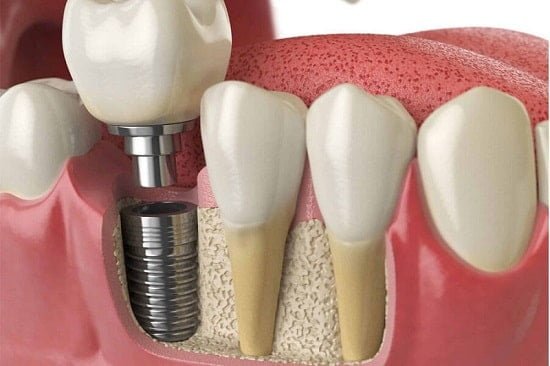 Trụ Implant Paltop: Ưu nhược điểm và chi phí 1 trụ răng