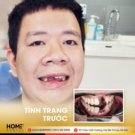 Trồng răng Implant xi măng và bắt vít