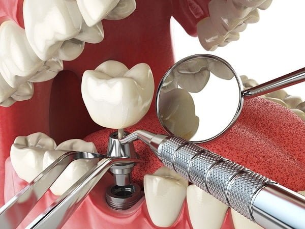 Top 14 địa chỉ trồng răng Implant ở Bình Dương uy tín