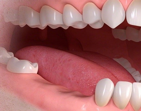 Mất răng số 6 và 7 - Cách khắc phục hiệu quả