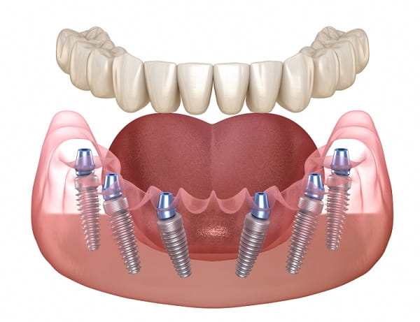 Top 7 nha khoa trồng răng Implant tại Hải Phòng