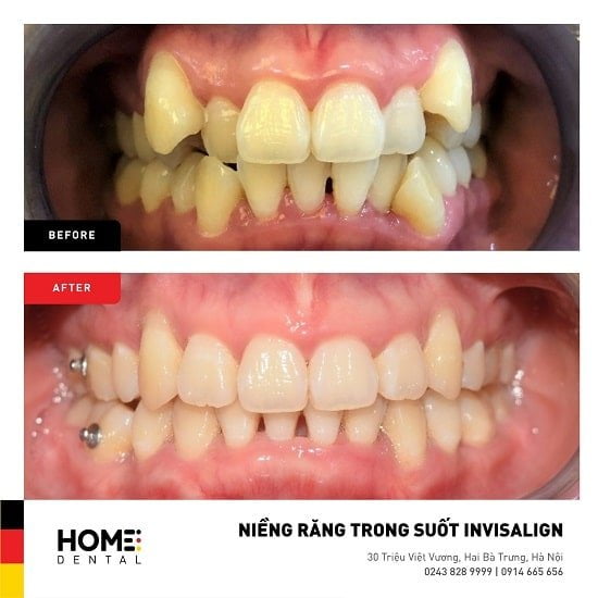 Hình ảnh trước và sau khi niềng răng trong suốt tại Nha Khoa Home