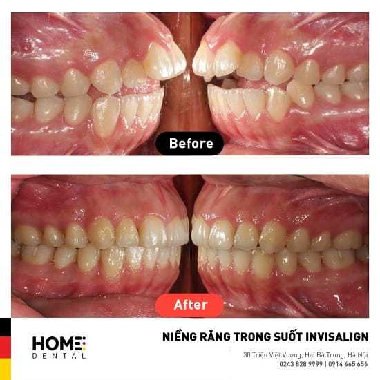 Hình ảnh trước và sau khi niềng răng trong suốt