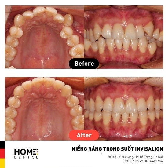 Hình ảnh trước và sau khi niềng răng trong suốt tại Nha Khoa Home