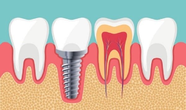 Top 9 địa chỉ trồng răng Implant ở Cần Thơ uy tín