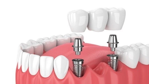Top 7 Địa chỉ trồng răng Implant Vũng Tàu uy tín