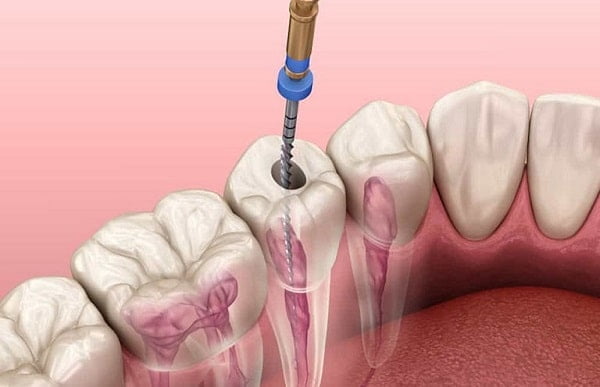 Răng đã lấy tủy tồn tại được bao lâu?