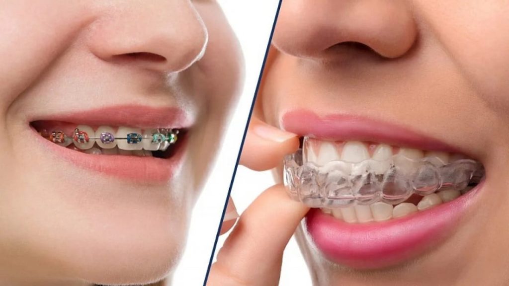 Sau khi tháo niềng răng phải đeo hàm duy trì bao lâu?