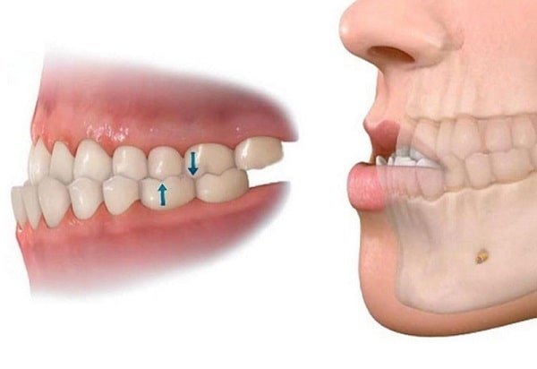 Quy trình niềng răng khớp cắn ngược