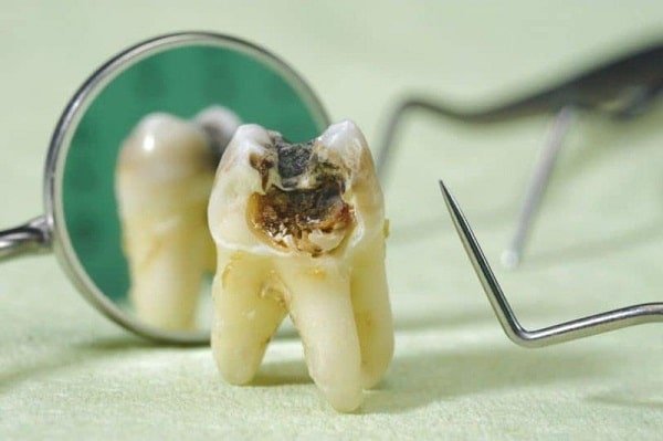 Nhổ răng hàm bị sâu có ảnh hưởng gì không?