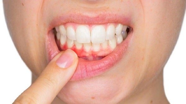 Sưng mộng răng có nguy hiểm không?