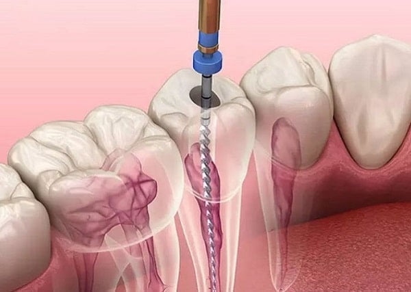 Cách giảm đau răng sau khi lấy tủy