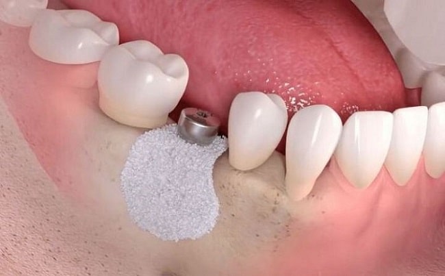 Nâng Xoang Kín Trong Cấy Ghép Implant Là Gì?