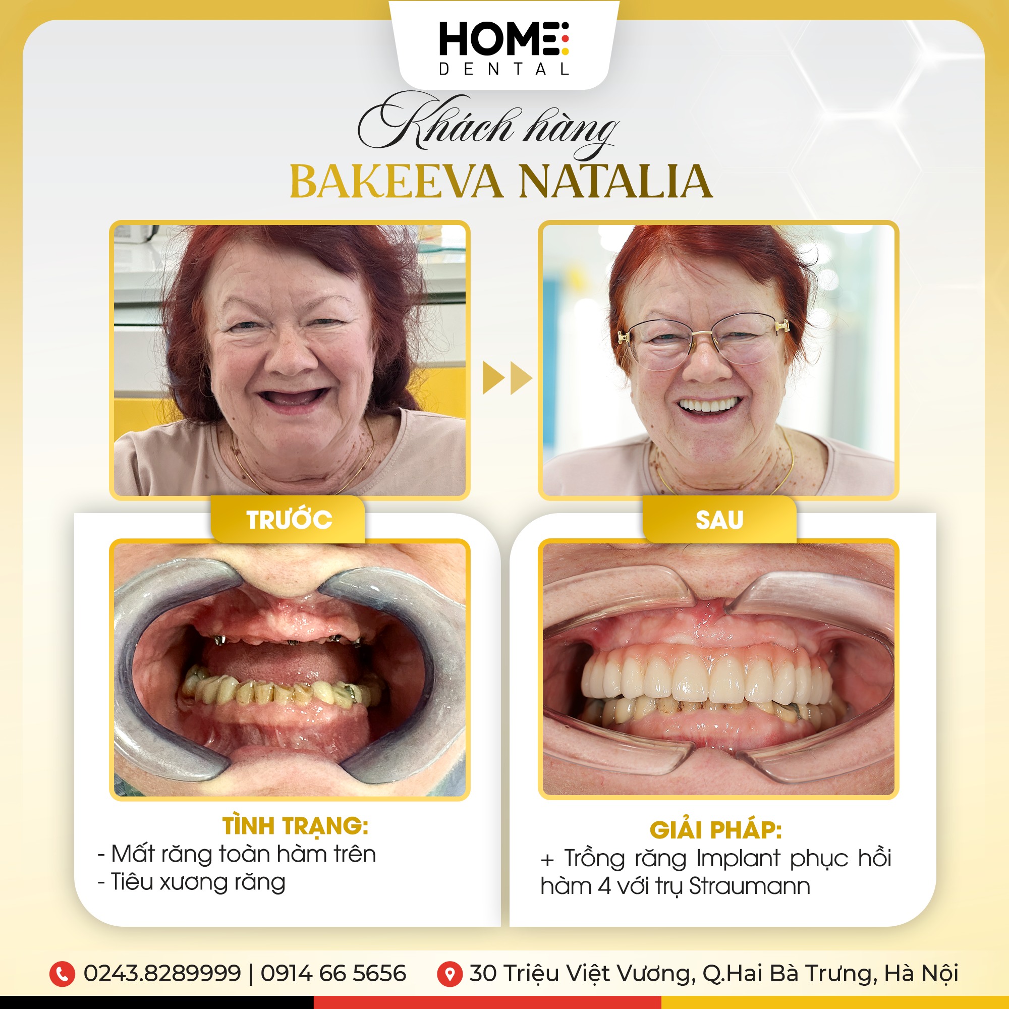 Bảng giá trồng răng Implant chuẩn y khoa tại nha khoa Home Dental - Nha Khoa Home
