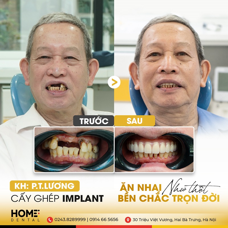 Trồng Răng Giả Cho Người Già Có Những Phương Pháp Nào? - Nha Khoa Home