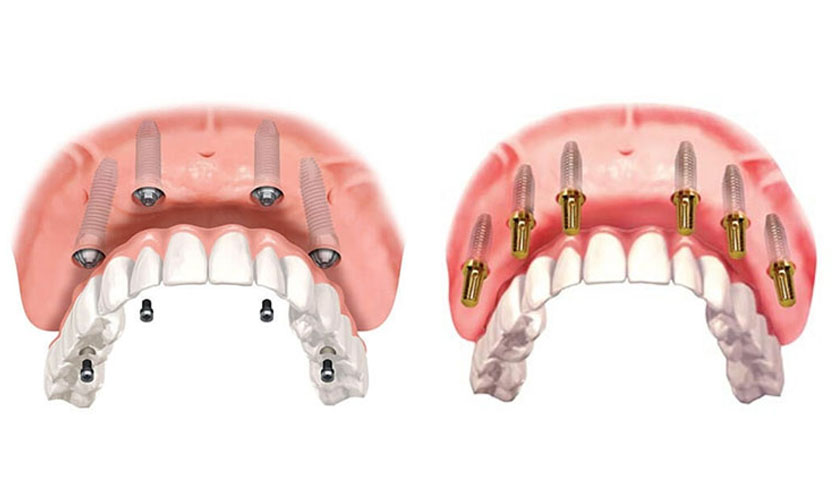 Trồng răng toàn hàm Implant All on 4 và All on 6 là gì?