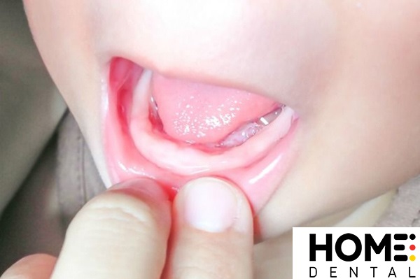 Hình ảnh trẻ sắp mọc răng cửa