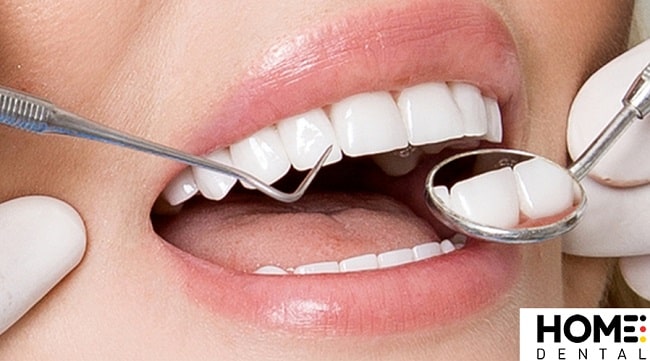 5 ưu điểm của dán sứ veener 