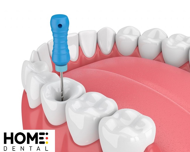 Răng lấy tủy có tồn tại được hết đời không