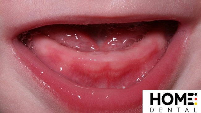 Hình ảnh lợi trẻ sắp mọc răng cửa dễ nhận biết