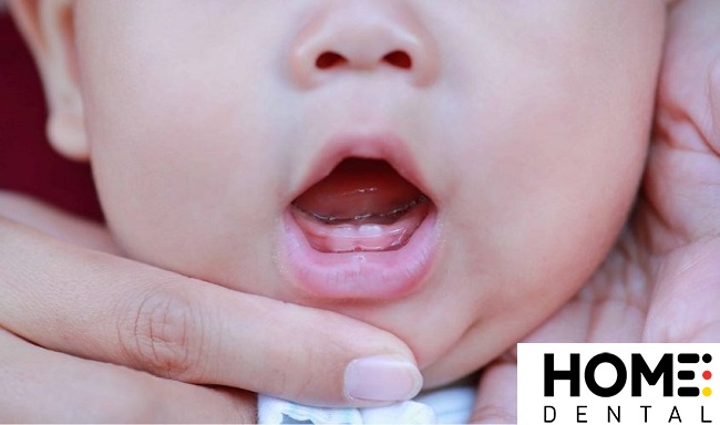 Hình ảnh lợi trẻ sắp mọc răng cửa