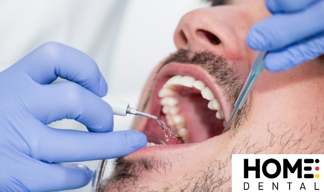 Có nên để vôi răng tự tróc không?